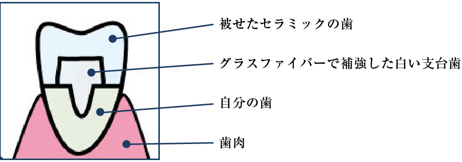 オールセラミックス