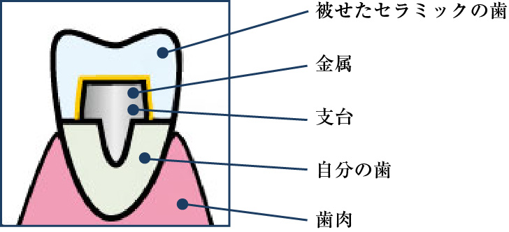 メタルボンド