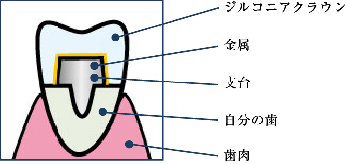 ジルコニアクラウン