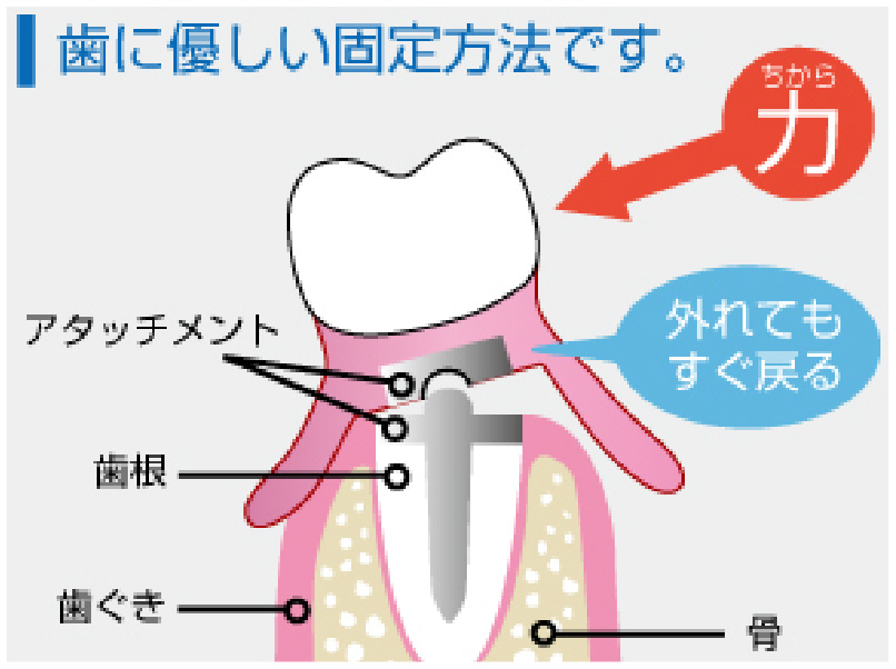 歯にやさしい固定方法です。