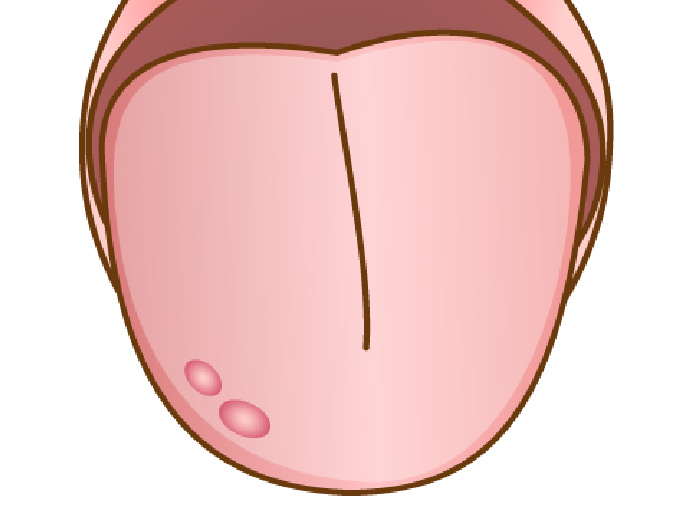良性腫瘍