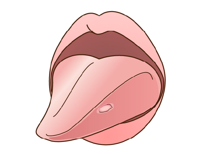 粘液嚢胞（ねんえきのうほう）
